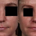 Non-Surgical Rhinoplasty Before and After Photos in Newburgh, NY, Patient 21776