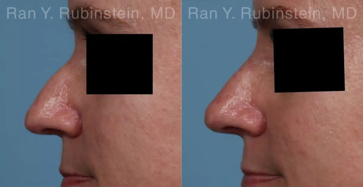 Non-Surgical Rhinoplasty Before and After Photos in Newburgh, NY, Patient 21776