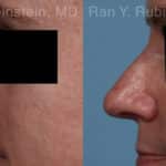 Non-Surgical Rhinoplasty Before and After Photos in Newburgh, NY, Patient 21776