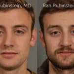 Rhinoplasty Before and After Photos in Newburgh, NY, Patient 21782