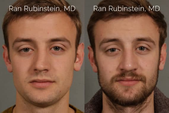 Rhinoplasty Before and After Photos in Newburgh, NY, Patient 21782