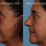 Rhinoplasty Before and After Photos in Montvale, NJ, Patient 21791
