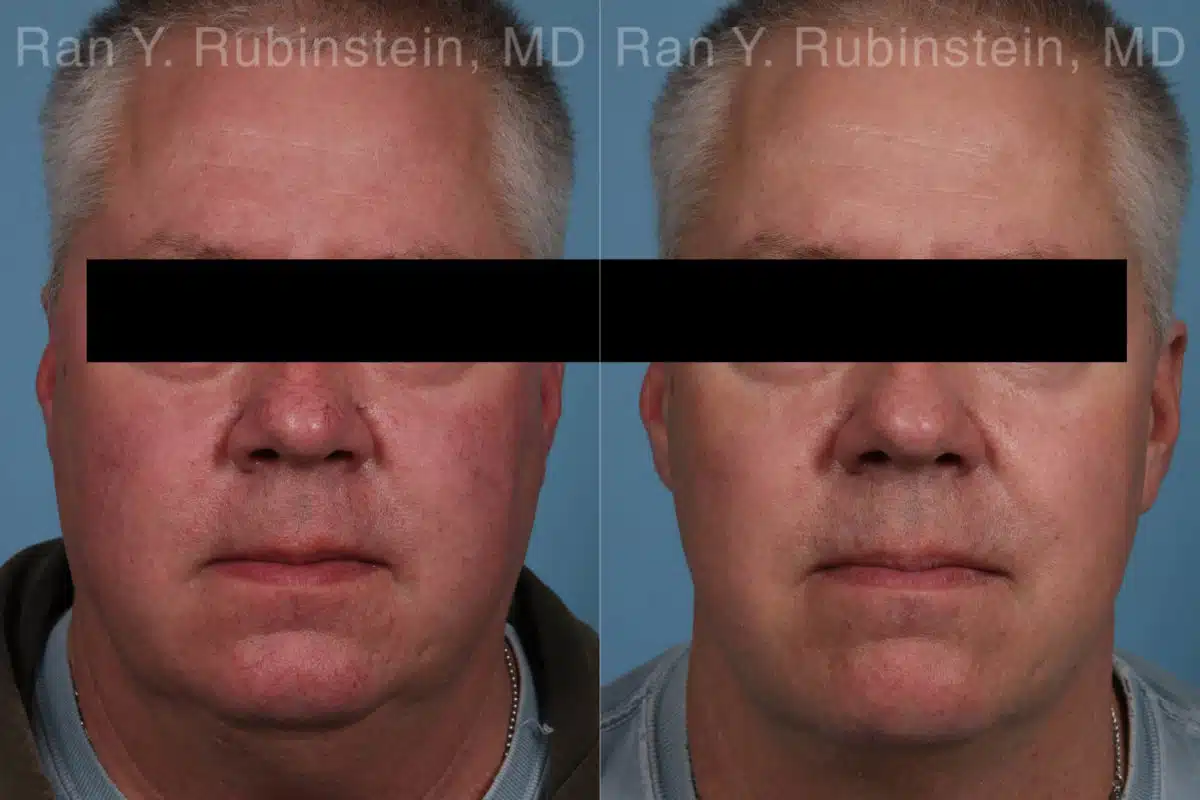 Laser Treatments Before and After Photos in Newburgh, NY, Patient 21864