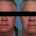 Laser Treatments Before and After Photos in Newburgh, NY, Patient 21864