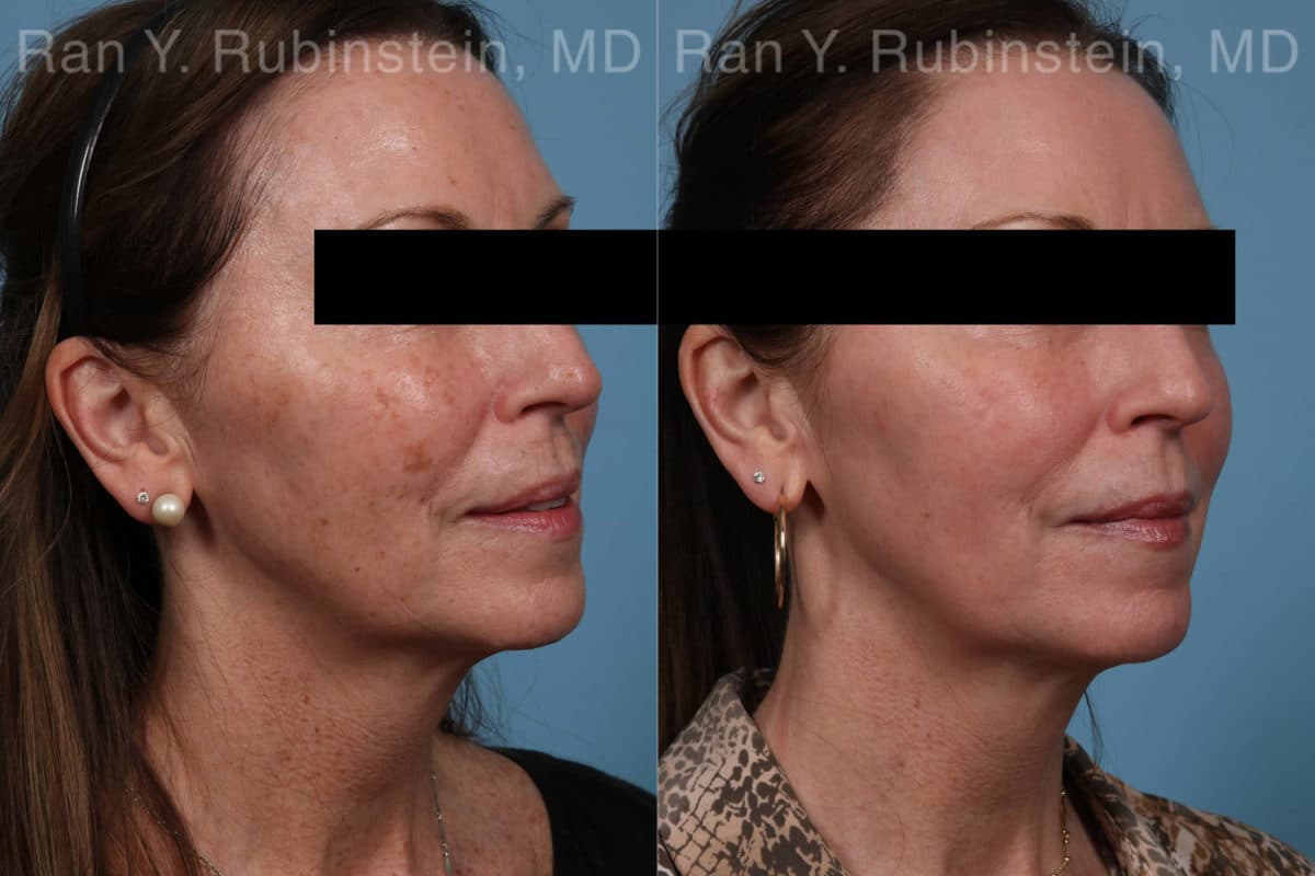 Laser Treatments Before and After Photos in Newburgh, NY, Patient 21869