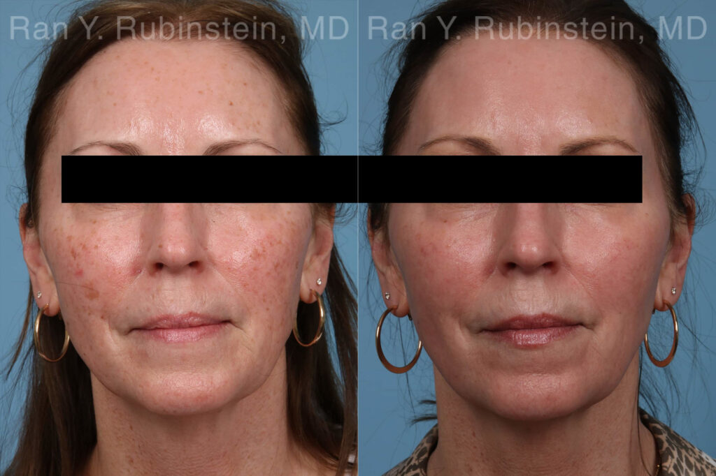 Laser Treatments Photos Newburgh, NY Patient 21869