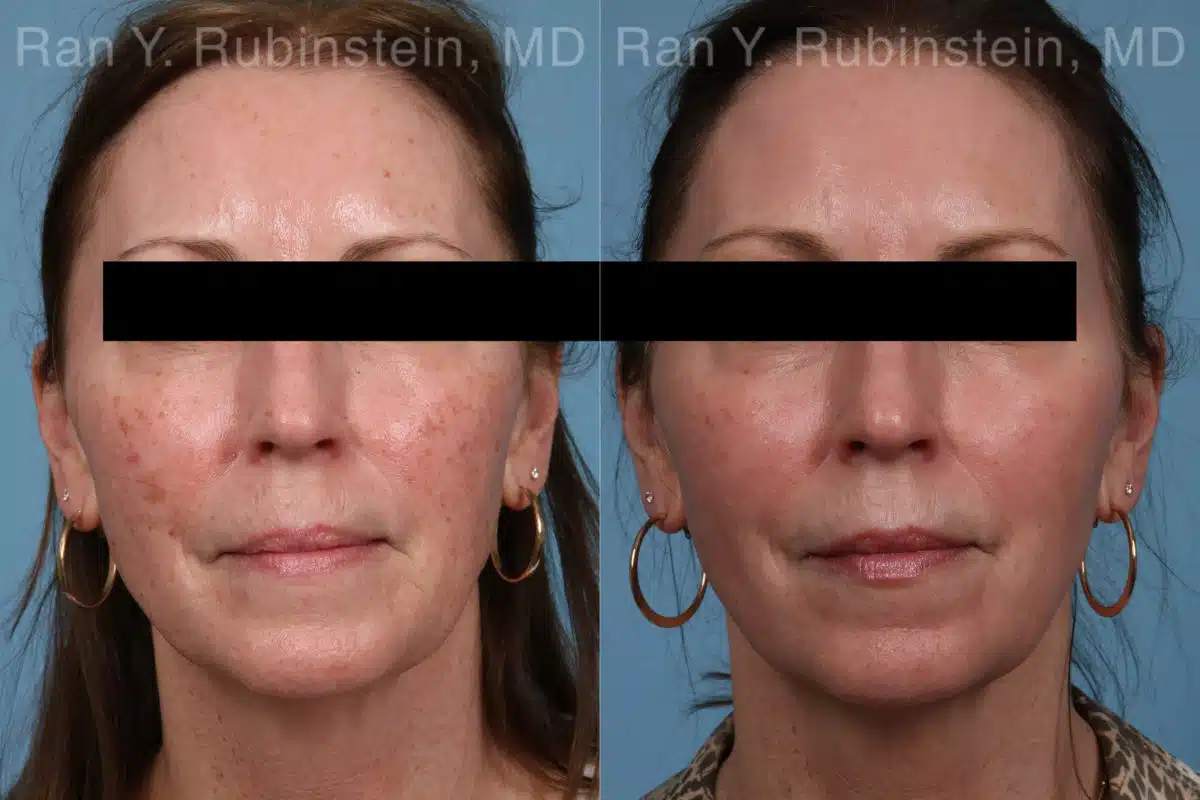 Laser Treatments Before and After Photos in Newburgh, NY, Patient 21869