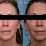 Laser Treatments Before and After Photos in Newburgh, NY, Patient 21869