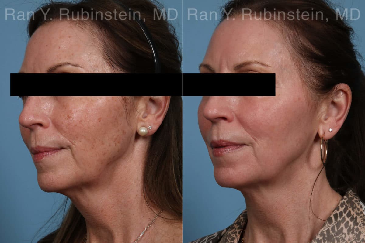 Laser Treatments Before and After Photos in Newburgh, NY, Patient 21869