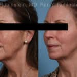 Laser Treatments Before and After Photos in Newburgh, NY, Patient 21869