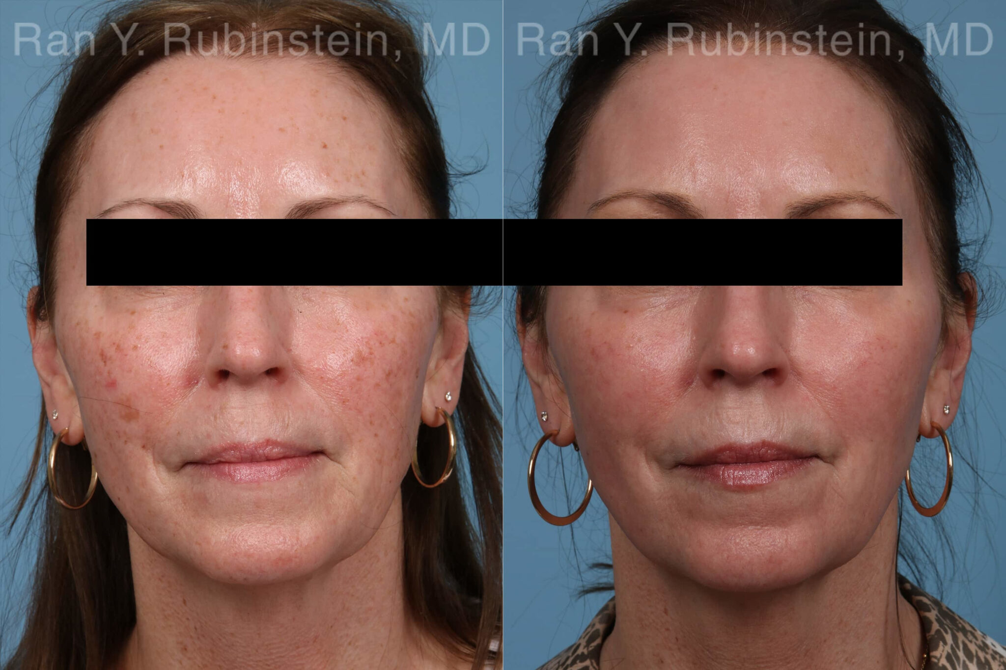 Laser Treatments Photos Newburgh, NY Patient 21869