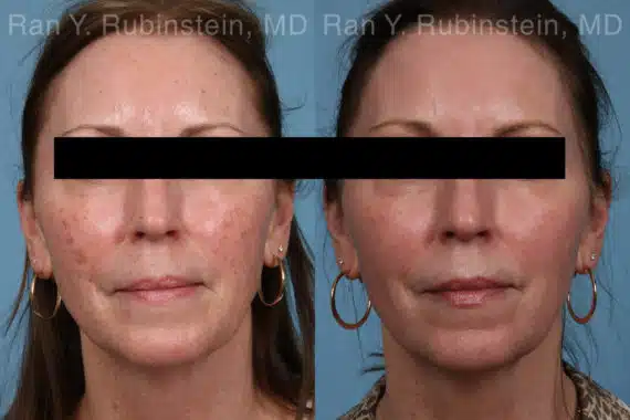 Laser Treatments Before and After Photos in Newburgh, NY, Patient 21869