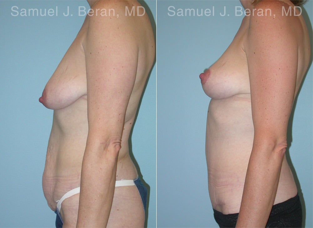 Mommy Makeover Before and After Photos in Newburgh, NY, Patient 12914