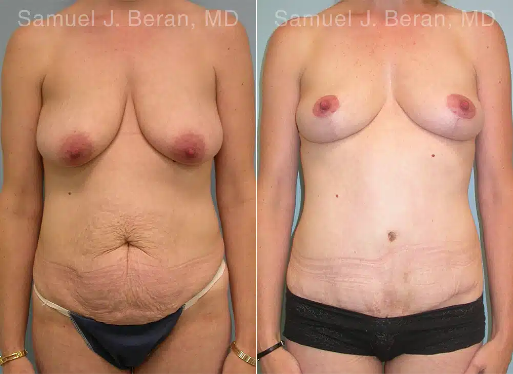 Mommy Makeover Before and After Photos in Newburgh, NY, Patient 12914