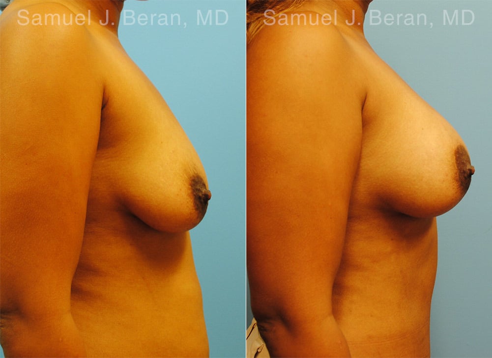 Mommy Makeover Before and After Photos in Newburgh, NY, Patient 12921