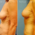 Mommy Makeover Before and After Photos in Newburgh, NY, Patient 12935