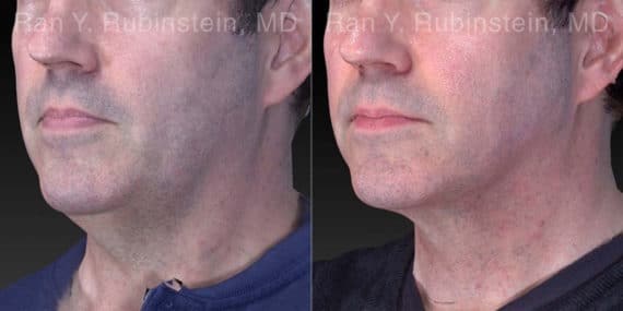 Laser Lift Precision Tx Before and After Photos in Newburgh, NY, Patient 21040