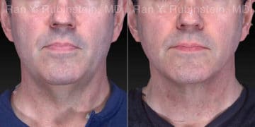 Laser Lift Precision Tx Before and After Photos in Newburgh, NY, Patient 21040