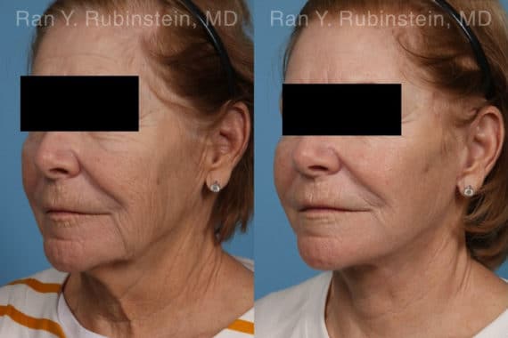 Face lift & Neck lift Before and After Photos in Newburgh, NY, Patient 21942