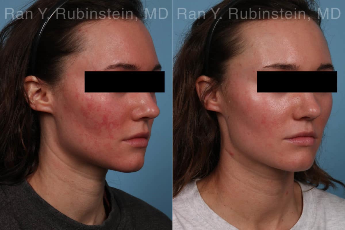 Laser Treatments Before and After Photos in Newburgh, NY, Patient 21994