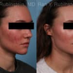 Laser Treatments Before and After Photos in Newburgh, NY, Patient 21994