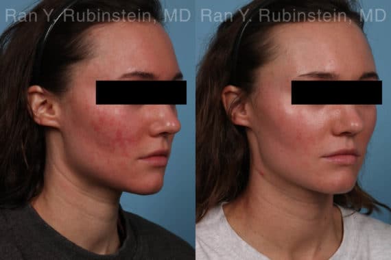 Laser Treatments Before and After Photos in Montvale, NJ, Patient 21994