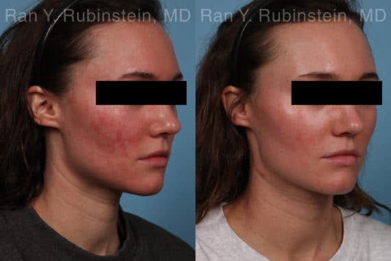 Laser Treatments Before and After Photos in Newburgh, NY, Patient 21994