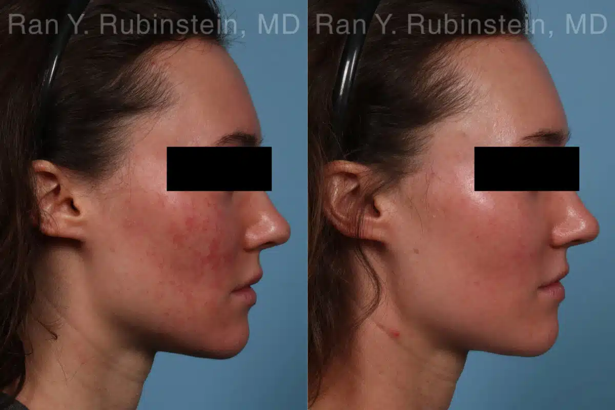 Laser Treatments Before and After Photos in Newburgh, NY, Patient 21994