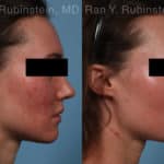 Laser Treatments Before and After Photos in Newburgh, NY, Patient 21994