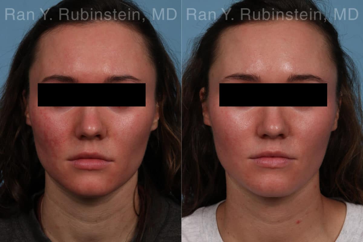 Laser Treatments Before and After Photos in Newburgh, NY, Patient 21994