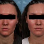 Laser Treatments Before and After Photos in Newburgh, NY, Patient 21994