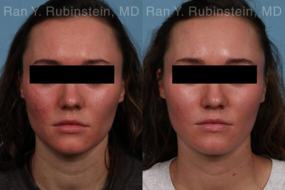 Laser Treatments Before and After Photos in Newburgh, NY, Patient 21994