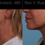 Laser Lift Precision Tx Before and After Photos in Newburgh, NY, Patient 22127