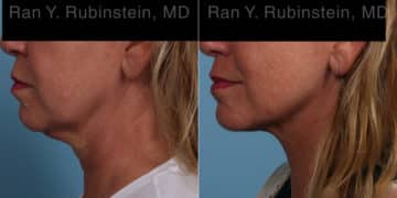 Laser Lift Precision Tx Before and After Photos in Newburgh, NY, Patient 22127