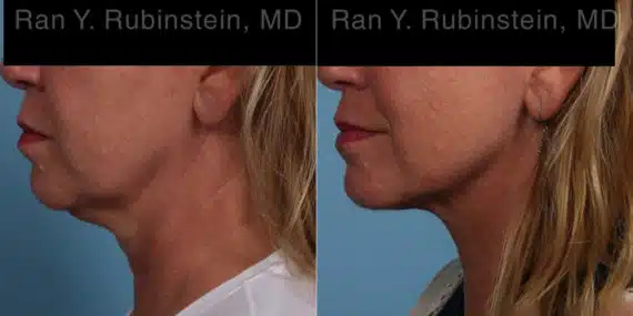 Laser Lift Precision Tx Before and After Photos in Newburgh, NY, Patient 22127