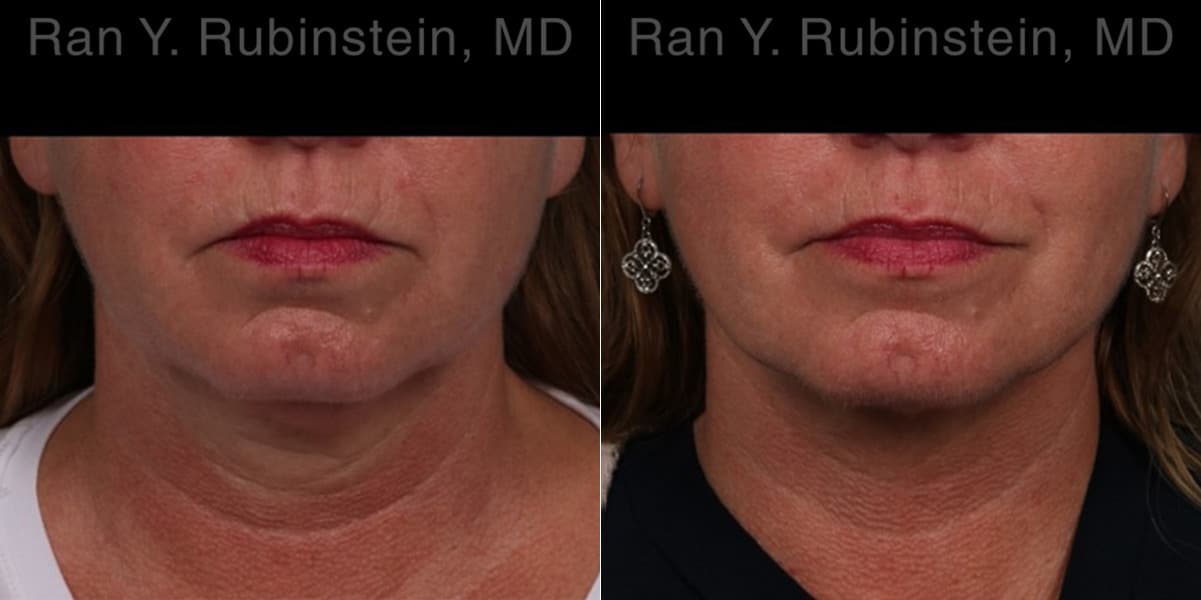 Laser Lift Precision Tx Before and After Photos in Newburgh, NY, Patient 22127