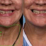 Laser Treatments Before and After Photos in Newburgh, NY, Patient 22149