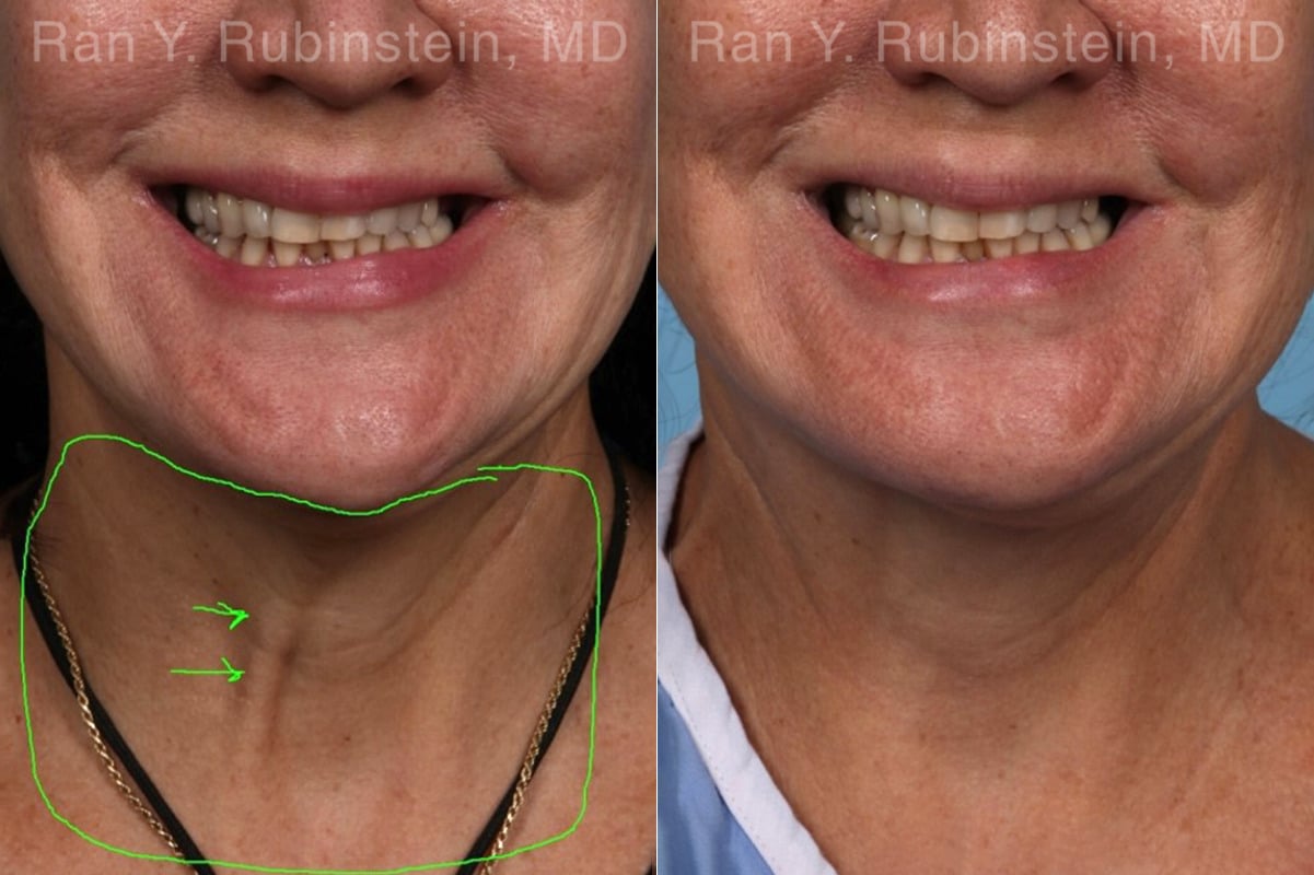 Laser Treatments Before and After Photos in Newburgh, NY, Patient 22149