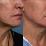 Laser Treatments Before and After Photos in Newburgh, NY, Patient 22149