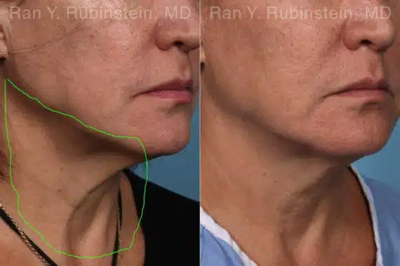 Laser Treatments Before and After Photos in Newburgh, NY, Patient 22149