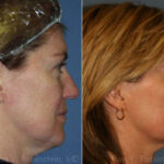 Skin Tightening Before and After Photos in Newburgh, NY, Patient 13178