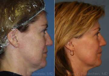 Skin Tightening Before and After Photos in Newburgh, NY, Patient 13178