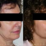 Skin Tightening Before and After Photos in Newburgh, NY, Patient 13196