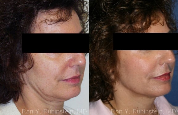 Skin Tightening Before and After Photos in Newburgh, NY, Patient 13196