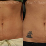 Skin Tightening Before and After Photos in Newburgh, NY, Patient 13207