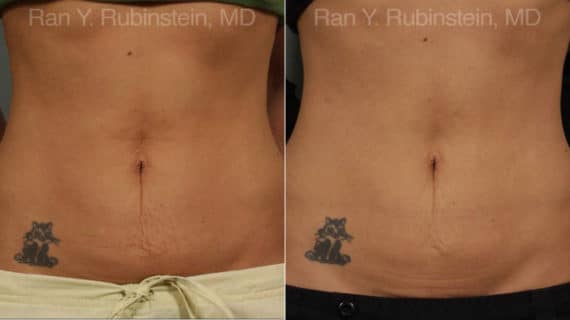 Skin Tightening Before and After Photos in Newburgh, NY, Patient 13207