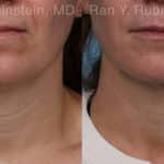 Laser Lift Precision Tx Before and After Photos in Newburgh, NY, Patient 19120