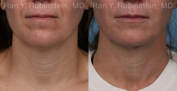 Laser Lift Precision Tx Before and After Photos in Newburgh, NY, Patient 19120