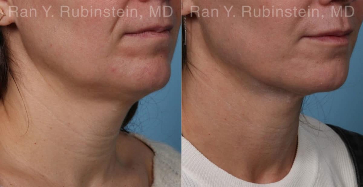 Laser Lift Precision Tx Before and After Photos in Newburgh, NY, Patient 19120