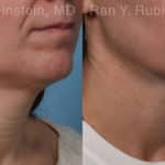 Laser Lift Precision Tx Before and After Photos in Newburgh, NY, Patient 19120